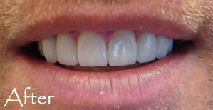 Teeth after porcelain veneers applied by Judy Huey DDS