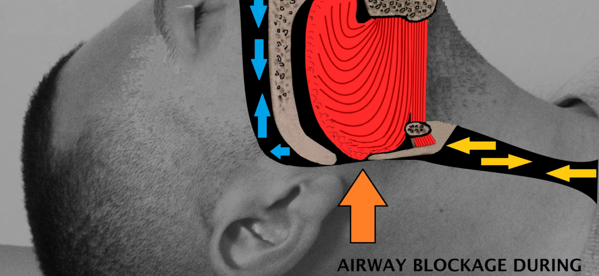 airway obstruction , oxygen, carbon dioxide, airway blockage during sleep apnea