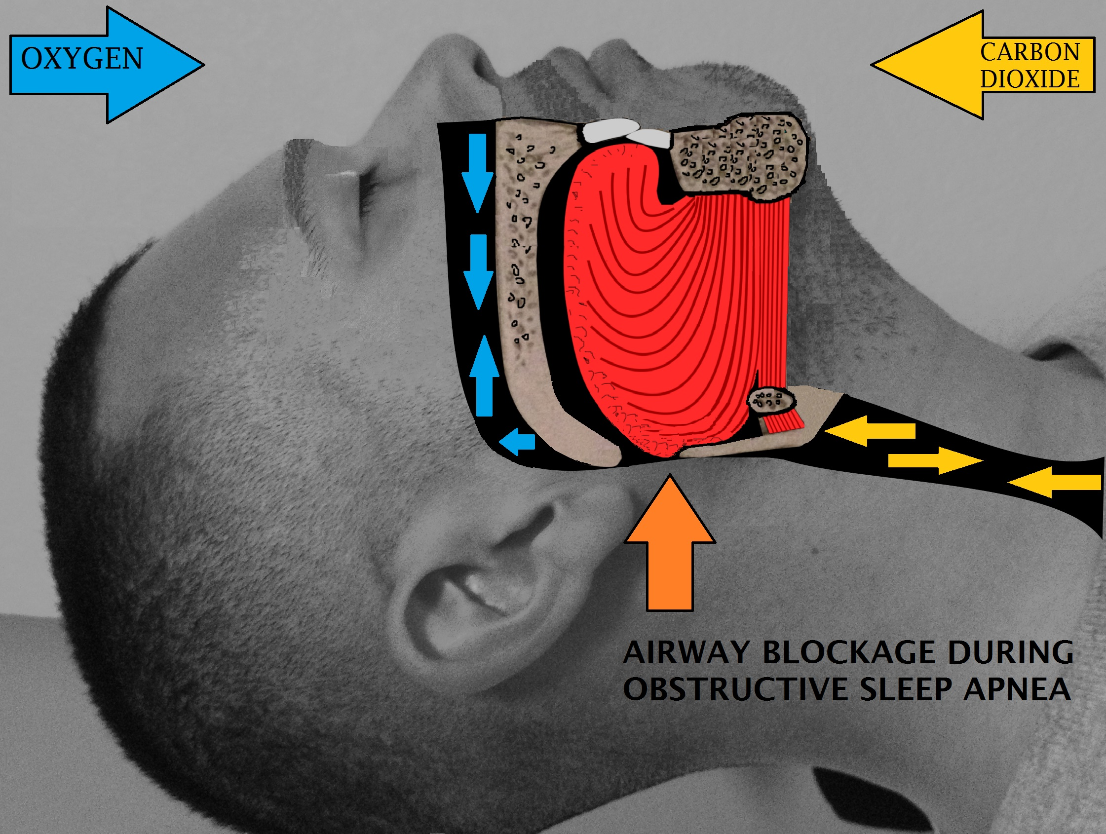 airway obstruction , oxygen, carbon dioxide, airway blockage during sleep apnea