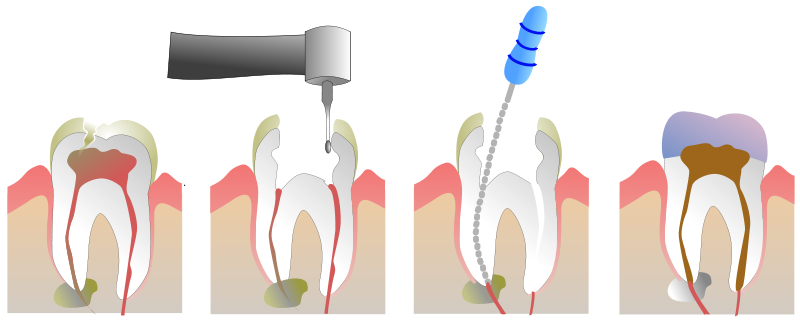 800px-Root_Canal_Illustration_Molar.svg