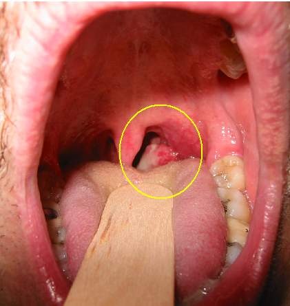 human papillomavirus on throat)